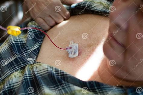 Port A Cath Implanted Under Skin In Woman S Upper Chest Stock Photo