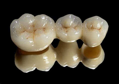 Crown And Bridge Dentistry Dental Planets