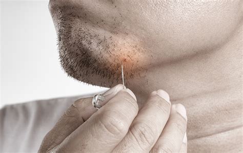 How To Get Rid Of Ingrown Hairs In Your Beard The Complete Guide