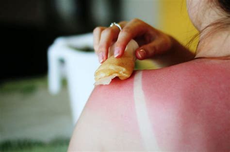 How long does it take for sun burn to go away? Sunburn treatment: How long does sunburn take to heal ...
