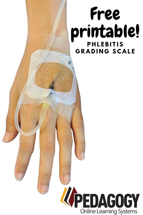 Phlebitis Should Be Documented Using A Uniform Standard Scale For
