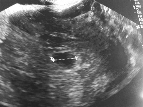 Cross Posted First Ultrasound At 5 6 Weeks