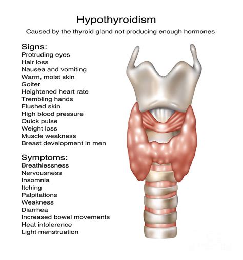 Hypothyroidism Illustration Photograph By Gwen Shockey Fine Art America