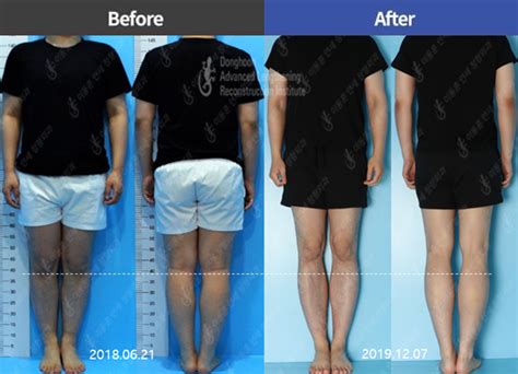Leg Shortening Surgery Before And After Photos