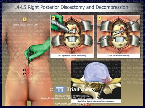 L4 L5 Right Posterior Discectomy And Decompression Trialexhibits Inc