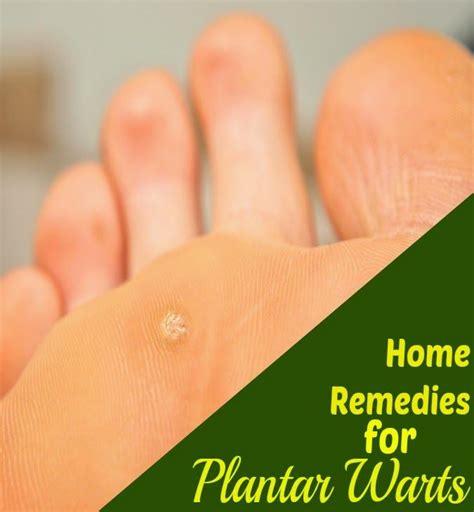 Home Remedies For Plantar Warts Home Remedies Remedies Health And