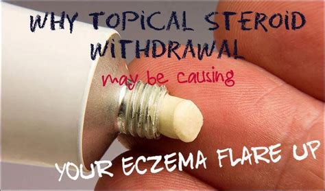 Steroid Cream For Eczema Eczemacreams Topical Steroid Withdrawal