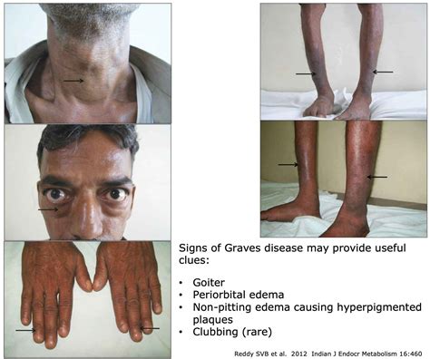 Signs Of Graves Disease • Goiter • Periorbital Grepmed