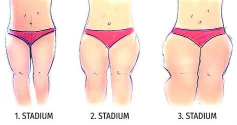 Ursachen, symptome, ernährung und behandlung. LipoKlinik Berlin | Fachklinik für Lipödem Behandlung