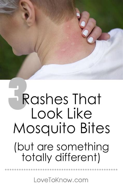 Bug Bites That Look Like Mosquito Bites But Aren T All Three Of These