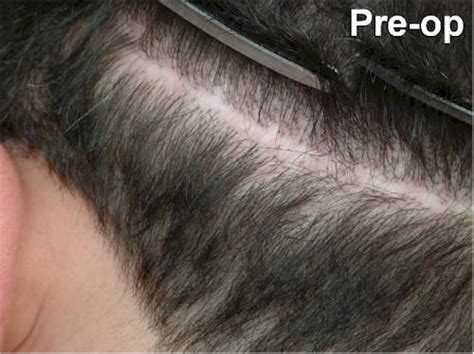 Dr Cole Hair Transplant Strip Scar Repairs Hair Restoration News