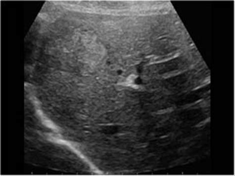 Abdomen And Retroperitoneum 11 Liver Case 111 Focal Nodular