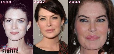 Celebrity Plastic Surgery Before And After 56 Pics