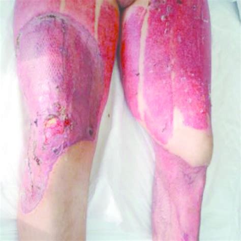 Mucormicosis cutánea primaria por rhizopus spp. Skin biopsy: Chromoblastomycosis diagnosis. Granulomatous ...