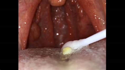 Removal Of Many Small Tonsil Stones Youtube