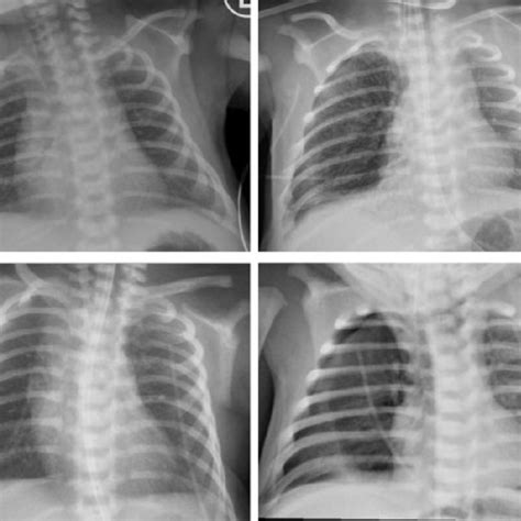 Chest Radiographs Of Both Cases Are Shown Here Case 1 On Admission