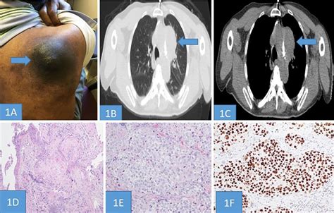 Figure 1 From Lung Cancer Presenting As Skin Metastasis Of The Back And