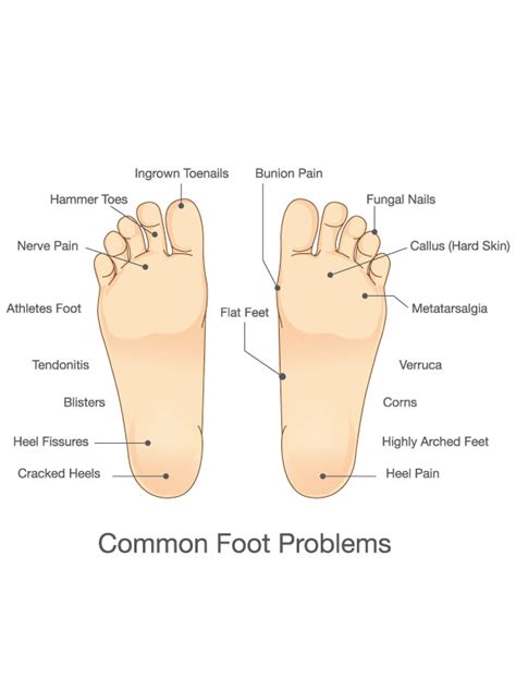 Services Basic Foot Care Diagram Mvs Podiatry Associates