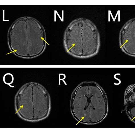 Brain Mri Findings From The Fifth And Sixth Mri Scans Fifth Mri Scan