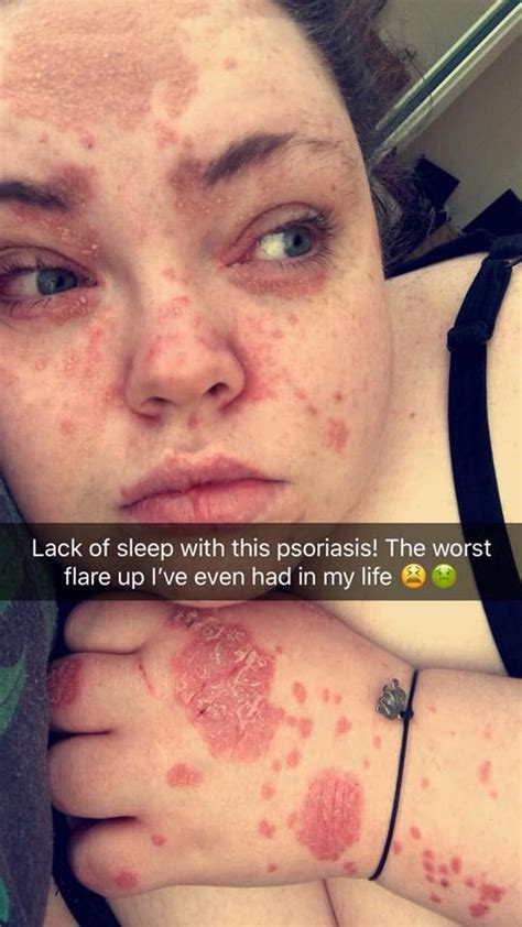 Video Psoriasis Sufferer Tells How 95 Per Cent Of Her Body Was Coated In Leopard Like Spots News