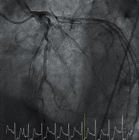 Coronary Angiography Lao Cranial View Showing Three Serial Critical
