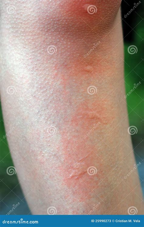 Mosquito Bite Stock Image Image Of Blood Virus Macro 25990273