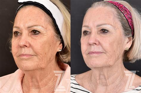 Before And After Photos Halo Laser Therapy Laser Medical Aesthetician