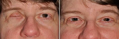 Patient Of Ocular Prosthetics Before And After Photos