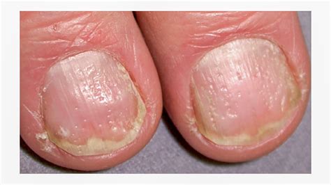 Psoriasis Of The Nails Images Tutorial Pics