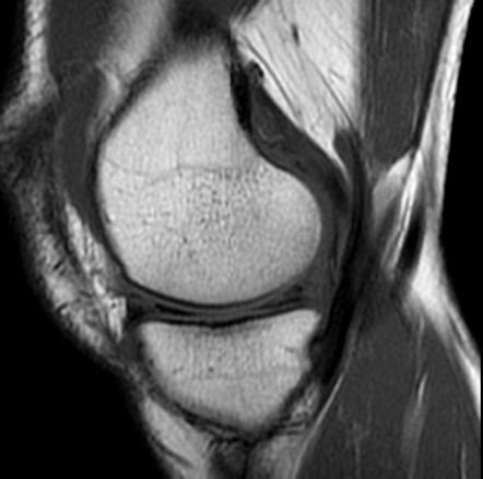 Hiányzik folyadék Megjegyzik posterior horn medial meniscus tear mri híd intervallum Terjeszteni