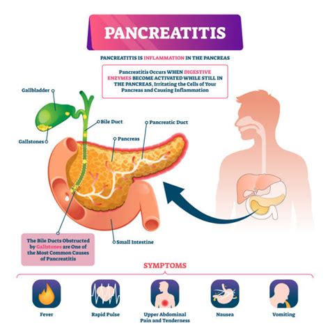 Pancreatitis Illustrations Royalty Free Vector Graphics And Clip Art