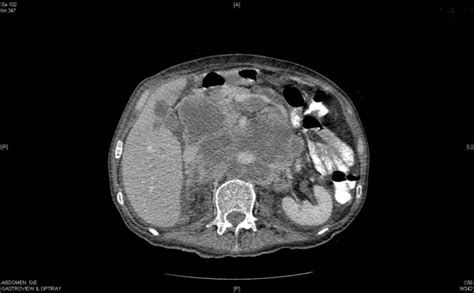 A Massive Conglomerate Of Periaortic Aortocaval Lymph Nodes And