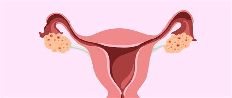 O Que São Foliculos Nos Ovarios Edukita