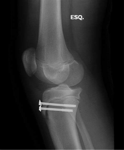 Rehabilitation Of Simultaneous Bilateral Epiphysial Fracture Of