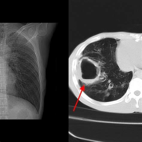 Chest Ct Scan Showed A Pig Tail Catheter In The Lung Cavity Of The