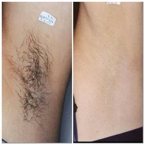 If you rush you may have nicks and cuts that we will have to avoid with the laser during your treatment. Before and after of underarms. This is great results from ...