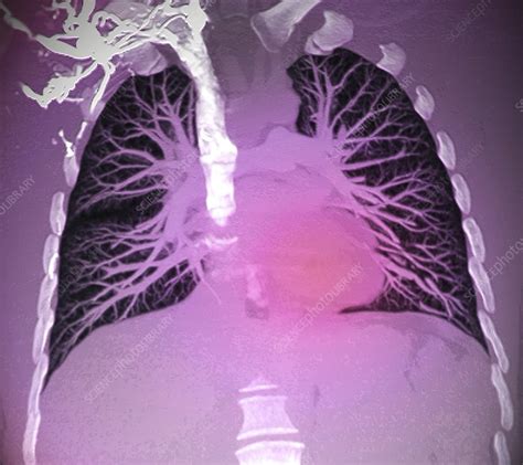 Blood Vessels Of Healthy Lungs Stock Image C0026483 Science