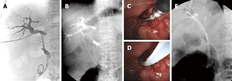 Guidewire Technique A The Percutaneous Transhepatic Biliary Drainage