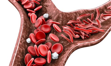 Pacientes Com Anemia Falciforme Causas Hemoglobina Pode Anemia Falciforme Pode Hemoglobina