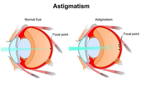 Astigmatism Vs Normal All You Need To Know