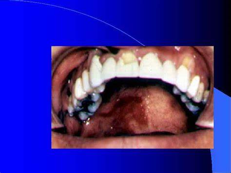 Вирус Эпштейн-Барр ДНКсодержащий семейство Herpesviridae l Плотные Картинка - Вирус Эпштейн-Барр ДНКсодержащий семейство Herpesviridae l Плотные