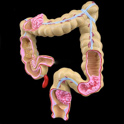 buy xiofya 1pc colorectal lesion model human colon large intestine pathological diseases model