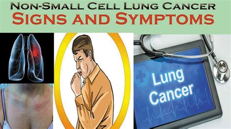 The Signs And Symptoms Of Lung Cancer Causes And Symptoms Of Nsclc