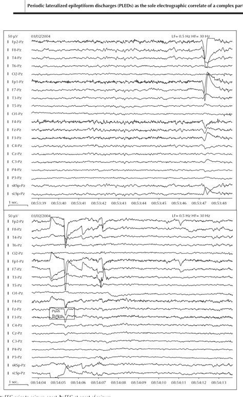 Figure 1 From Periodic Lateralized Epileptiform Discharges Pleds As