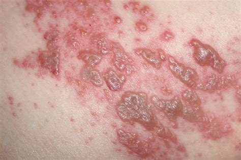A Suspected Viral Rash In Pregnancy The Bmj