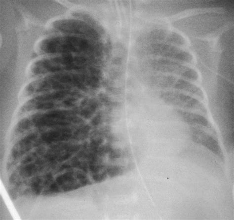 Pulmonary Interstitial Emphysema Radiology Hot Sex Picture