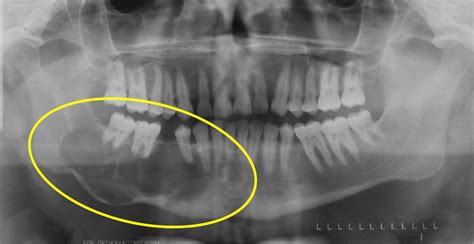 E Is For Edge Lesion Dr Gs Toothpix