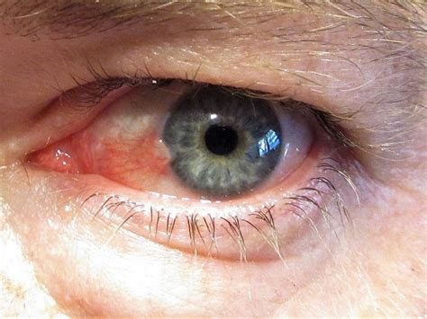There Is A White Spot On My Eye Small White Spot On Iris Of Eye