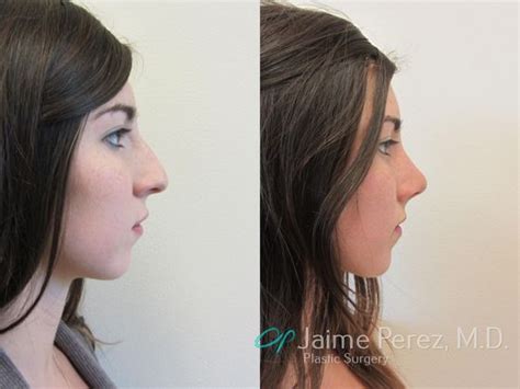 2 Weeks After Nose Job Nose Job Rhinoplasty Before And After Gallery