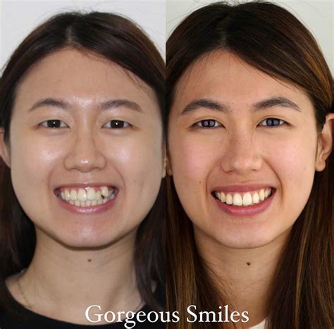 Braces Before And After Pictures Gorgeous Smiles